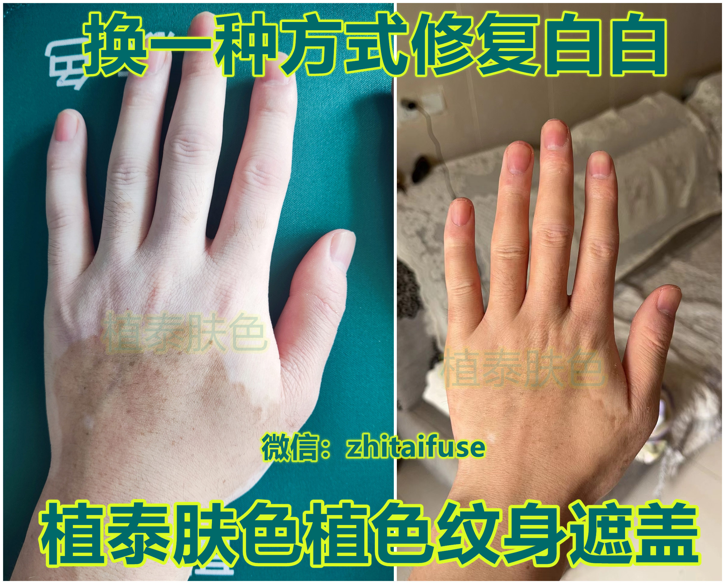 人工肤色植色纹身遮盖白癜风